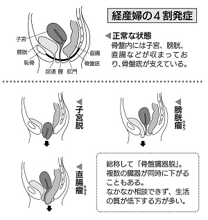 高齢の女性は注意 骨盤臓器脱 の予防と治療について 勤医協札幌病院